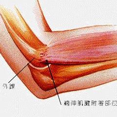 网球症怎么治疗最好（网球肘的最佳治疗方法，别错过最佳的康复时间，记得关注收藏！）